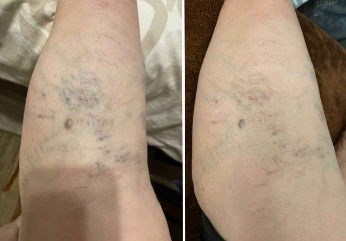 Before and after: appearance and condition of leg skin